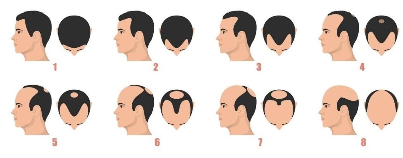 Faser av manligt håravfall.