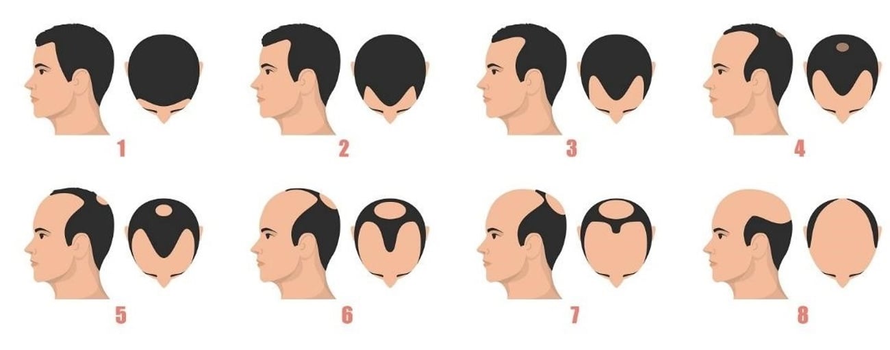 Faser af hårtab hos mænd.