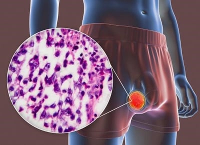 Medicinsk 3D-illustration af testikelkræft