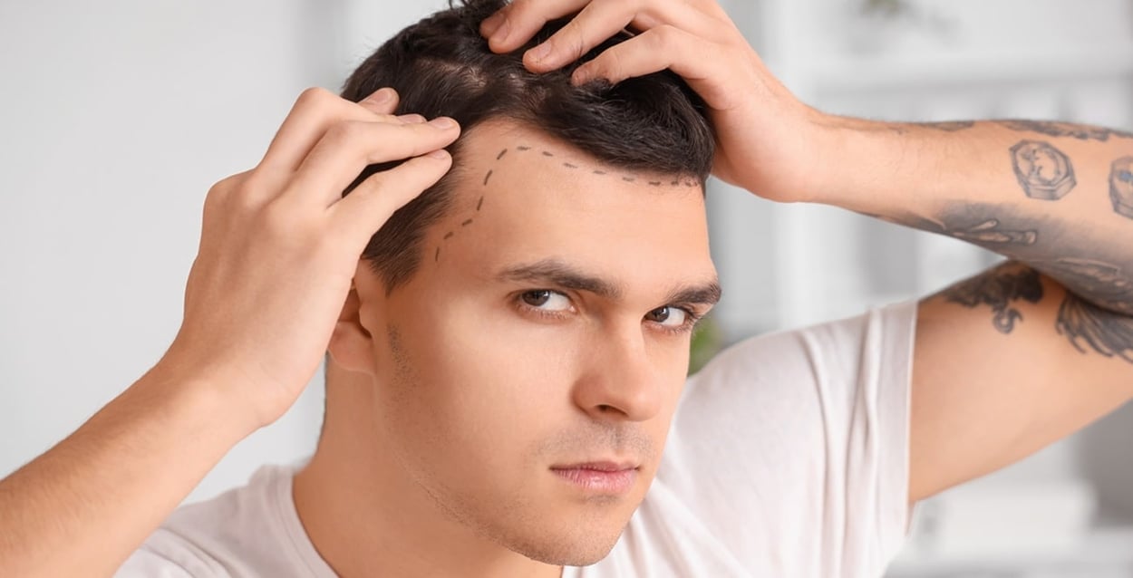 Junger Mann mit Haarausfallproblem und markierter Stirn in der Klinik