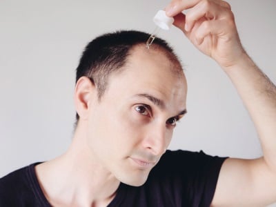 Ein Mann, der Medikamente gegen androgenetischen Haarausfall anwendet.