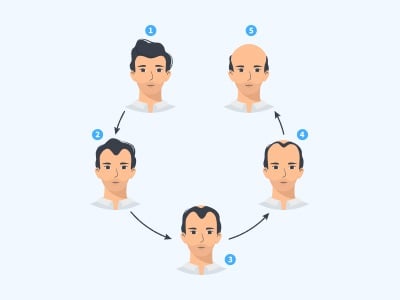 Eine Visualisierung der Phasen der männlichen adnrogenetischen Alopezie.