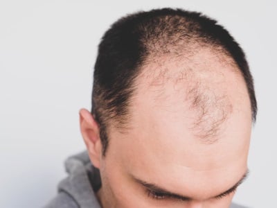 Ein Mann mit dem typischen Muster der adnrogenetischen Alopezie.