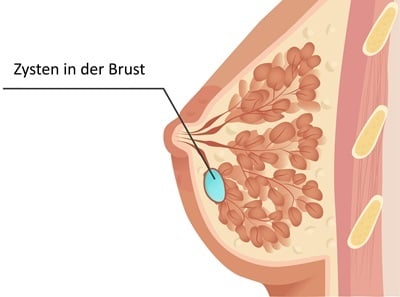 Visualisierung einer Zyste in der Brust