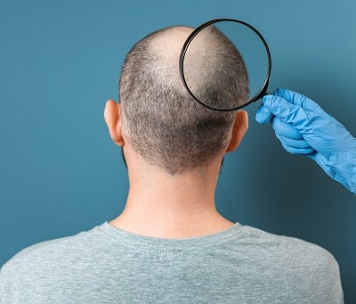 Ein Mann, der an Alopezie leidet, wird von einem Trichologen untersucht.