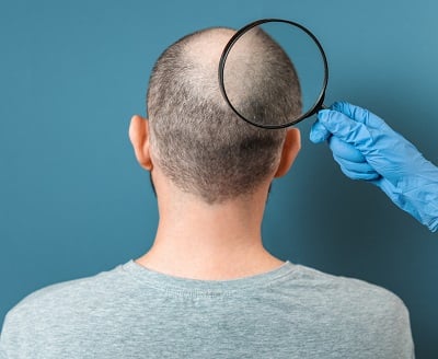 Ein Mann wird wegen Haarausfall untersucht.  