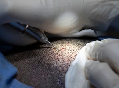 Haartransplantationsverfahren