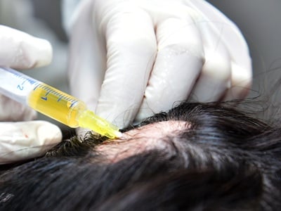 Ein Mann erhält eine Mesotherapie-Vitamincocktail-Injektion gegen Haarausfall