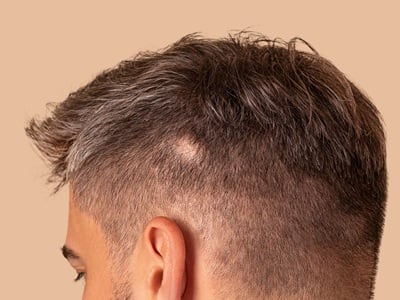 Ein Mann mit Haarausfall vom Typ Alopecia areata
