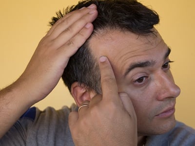 Ein Mann mit genetischem Haarausfall vom Typ androgenetische Alopezie