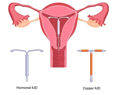 Hormonspirale und Kupferspirale und Bild der Spiraleinlage in der Gebärmutter