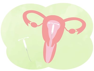 Illustration einer weiblichen Gebärmutter mit eingelegter Spirale