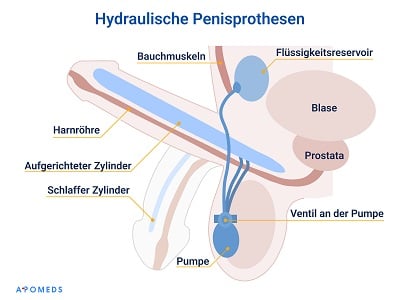 Ein Vektorbild der Funktion eines Penisimplantats.
