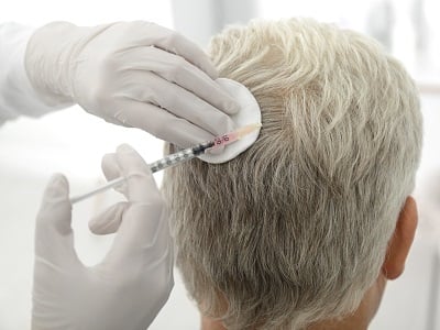 Ein Arzt injiziert eine Mesotherapie-Lösung in den Kopf eines Mannes.