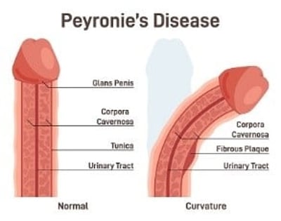 Grafisk illustration af Peyronies sygdom