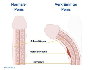 Eine schematische Darstellung eines normalen und eines gekrümmten Penis