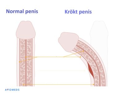 En schematisk framställning av en normal och en böjd penis