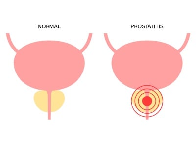 Ein Vektorbild einer normalen und einer entzündeten Prostata