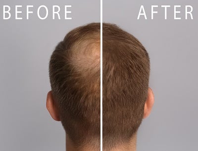 Mann mit Haarausfallproblem vor und nach der PRP-Behandlung