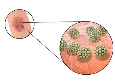 Ein Bild von Viruszellen und Feigwarzen, die durch HPV verursacht werden