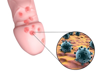 Ein Bild von Viruszellen und genitalen Läsionen, die durch Herpes genitalis verursacht werden