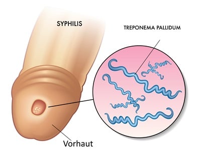 Syphilis-Schanker auf dem Penis