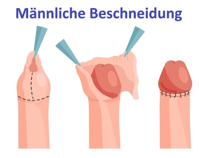 Ein Vektorbild der männlichen Beschneidung
