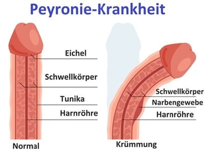 Schematische Darstellung der Penisverkrümmung bei der Peyronie-Krankheit