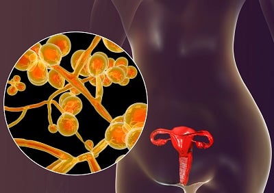 3D-Darstellung einer Vaginitis durch Pilzinfektion (Candidas).