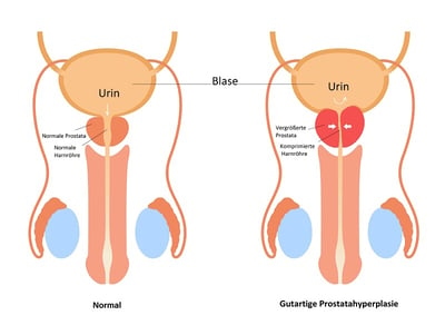 Eine schematische Darstellung der normalen Prostata im Vergleich zur gutartigen Prostatahyperplasie